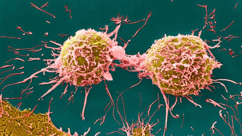 Rak materničnega vratu